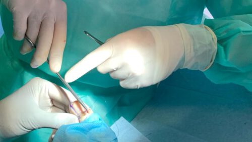 podólogo cosiendo dedo gordo del pie durante una matricectomía ungueal por uña encarnada