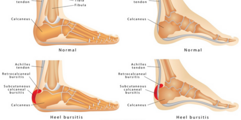 ¿Qué es la bursitis en el pie y cómo puede afectar a tu salud?