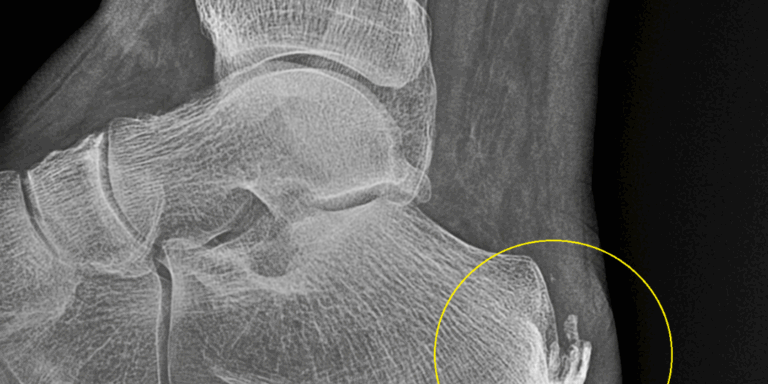 Calcificaciones en el tendón de Aquiles: causas y tratamiento